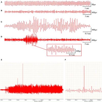 Identification of MicroRNA–Potassium Channel Messenger RNA Interactions in the Brain of Rats With Post-traumatic Epilepsy